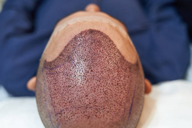 densité capillaire