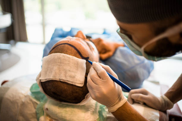 La méthode FUE signifie Follicular Unit Extraction. Elle est une technique moderne de greffe capillaire. En effet, elle permet