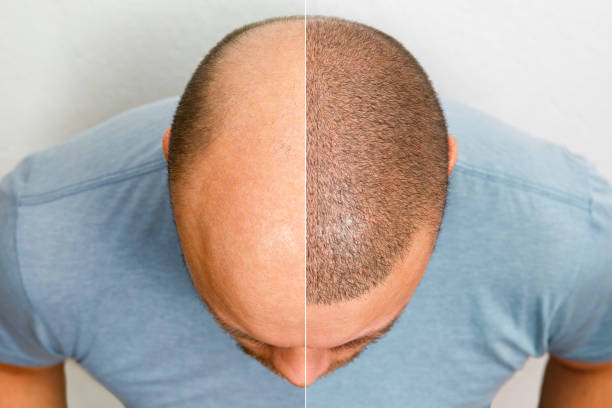 En cas de calvitie, le sommet du crâne est souvent la première zone concernée. En effet, cette région appelée aussi tonsure,