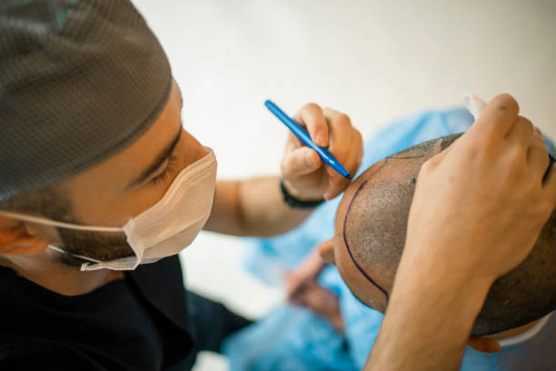 De nombreux patients redoutent l’acte chirurgical d’une greffe capillaire. En effet, bien que cette technique soit efficace,