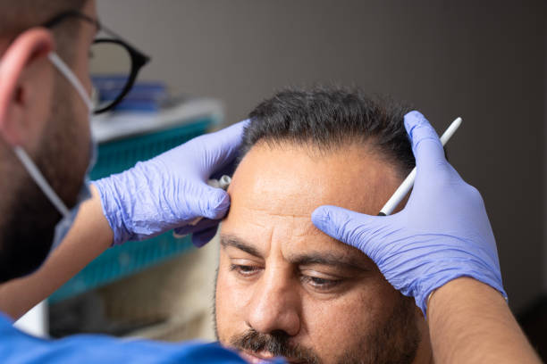 Après une greffe de cheveux, il faut respecter une phase de repos. En effet, le cuir chevelu reste très fragile. De ce fait,